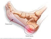 Illustration of foot with plantar fasciitis