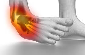 Illustration of an ankle sprain