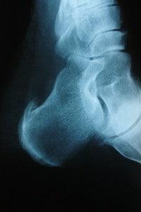 What do Heel Spurs Feel Like? - Medi-Dyne Healthcare Products