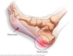 Illustration of foot with plantar fasciitis