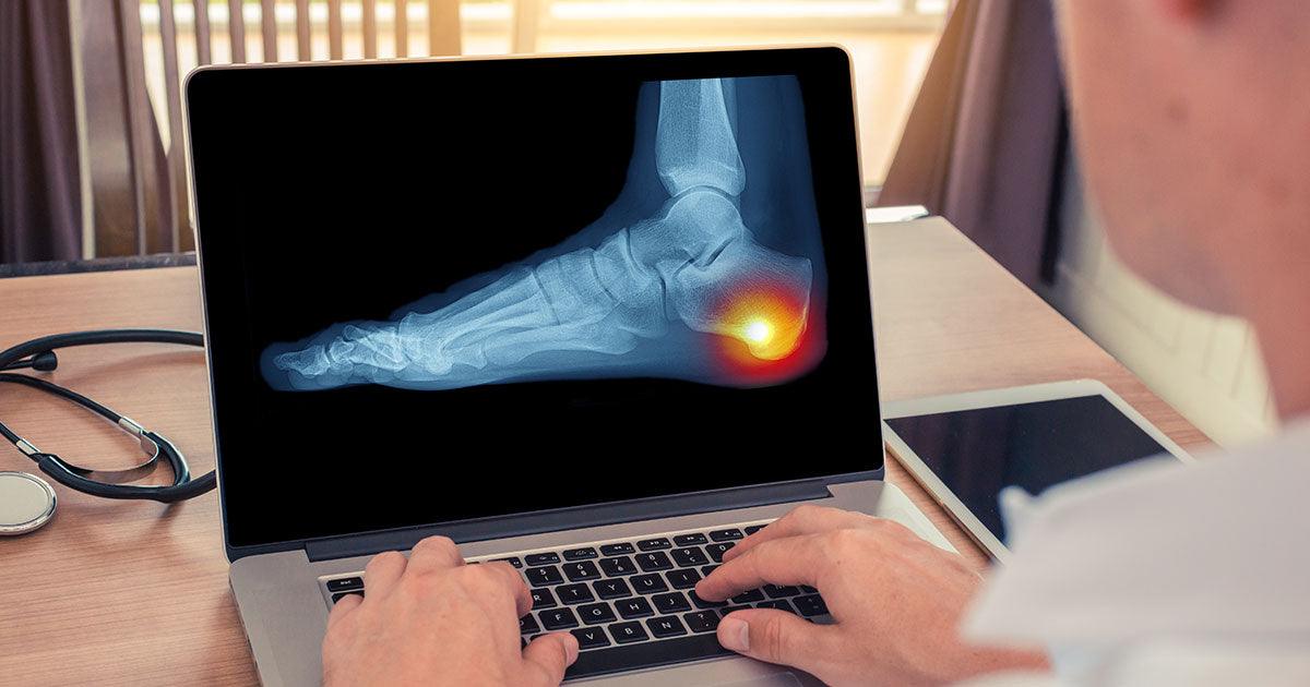 Doctor analyzing x rays of heel pain due to plantar fasciitis