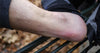 Foot Blister due to friction burn
