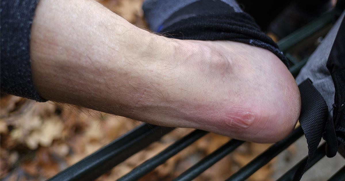 How To Use Chafing Blister Protection Effectively