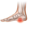 Proven Heel Pain Solutions - Medi-Dyne Healthcare Products