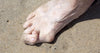 Foot with hammertoe